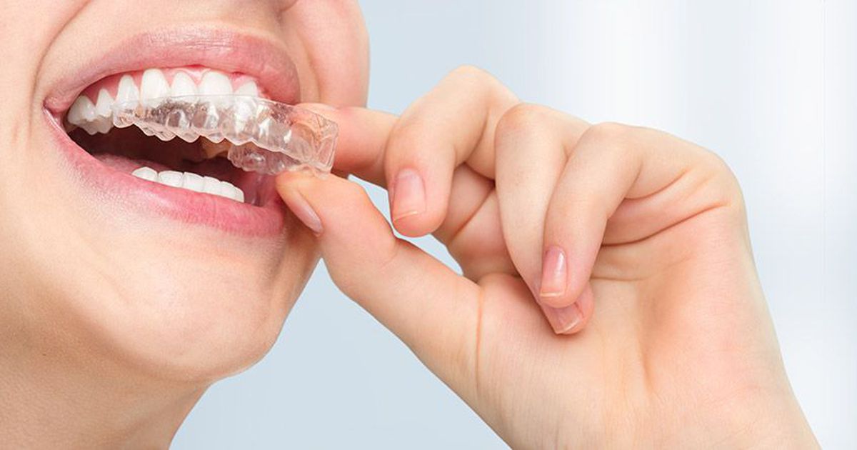 Invisalign